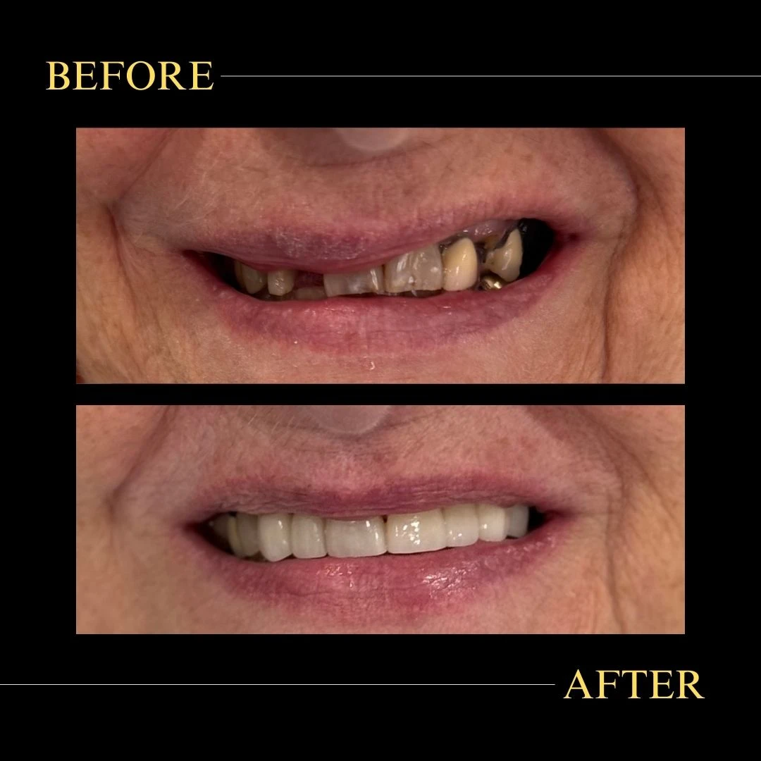 dental restoration showing severely damaged teeth replaced with a full set of white, healthy teeth.