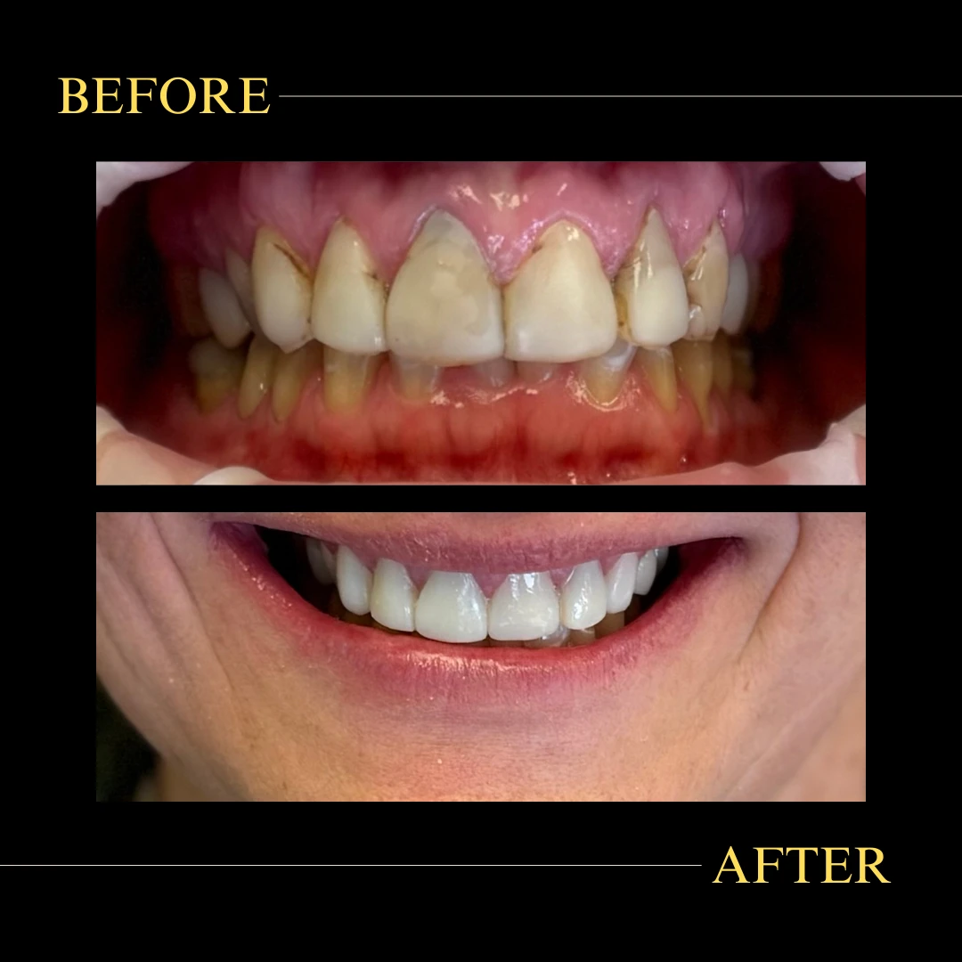 a smile makeover, with stained and misaligned teeth transformed into straight, white teeth.